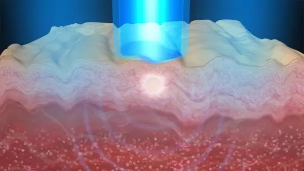 Picofocus How It Works Chroma Dermatology